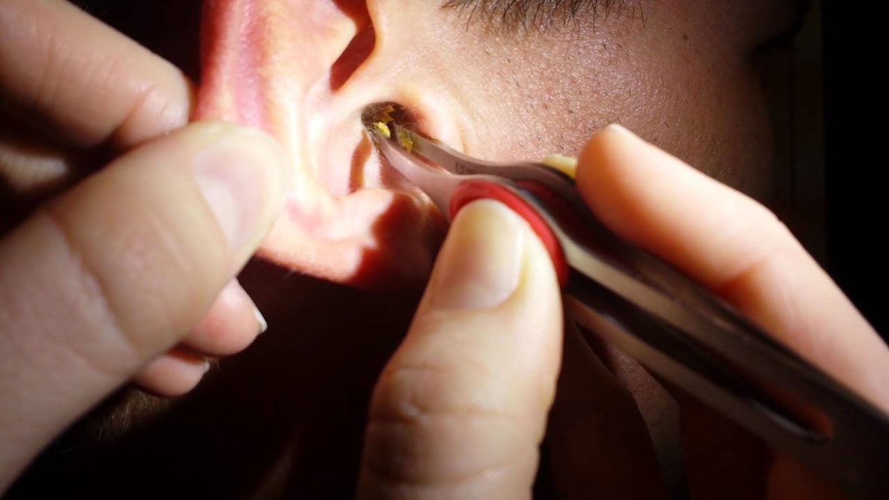 Trusted Ear Wax Removal in Nottingham: Professional Care Near You